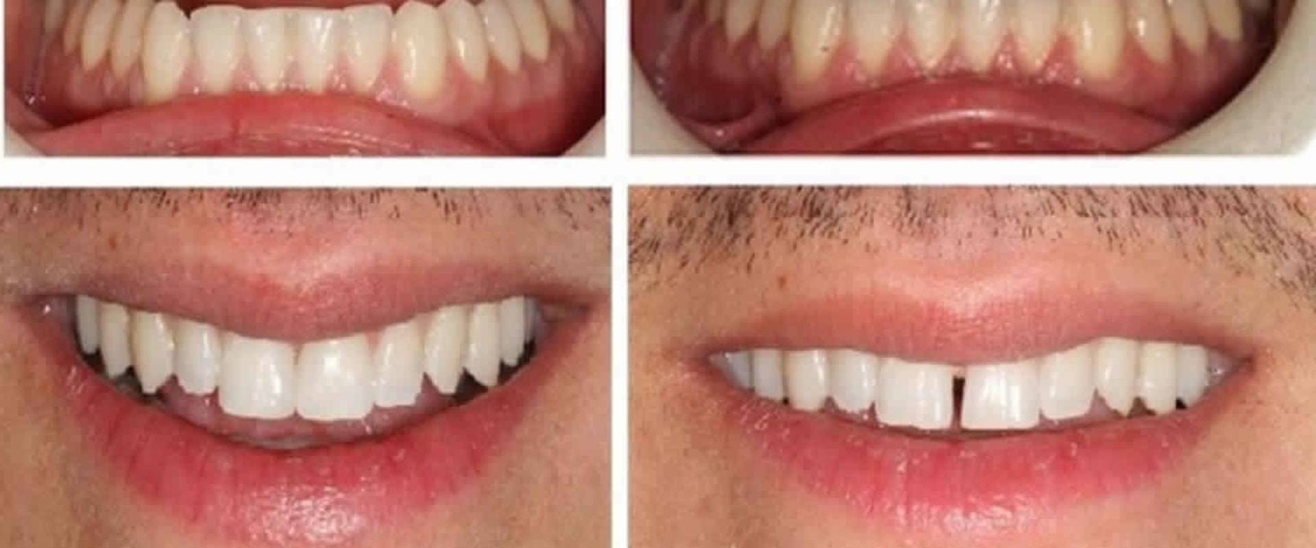 What is Cosmetic Dental Bonding and How Can it Help You?