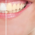Why cosmetic dental?