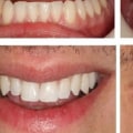 What is cosmetic dental bonding?