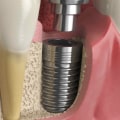 What is Cosmetic Dental Services and How Can It Help You Achieve Your Goals?