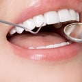 How Long Does it Take to Get Veneers?