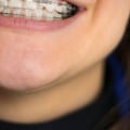 Does cosmetic dentistry include braces?