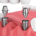 What are Dental Implants and How are They Classified?