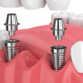 What are dental implants classified as?