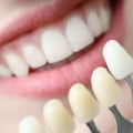 What is the best teeth makeover?
