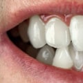 Can cosmetic dentistry fix crooked teeth?