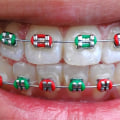Can You Get Braces for Aesthetic Reasons?