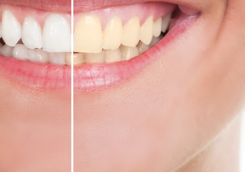 The Benefits of Cosmetic Dentistry: A Comprehensive Guide