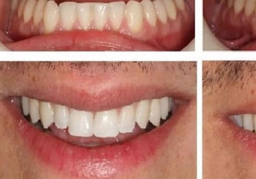 What is cosmetic dental bonding?