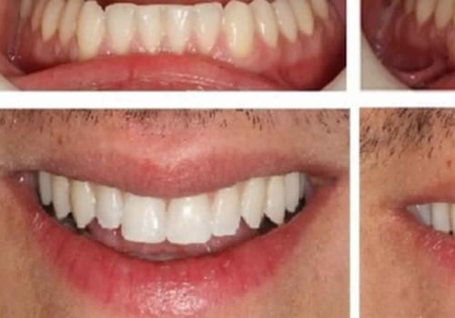 How Long Does Cosmetic Bonding Last?