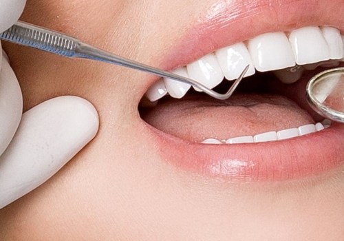 How long do veneers take from start to finish?