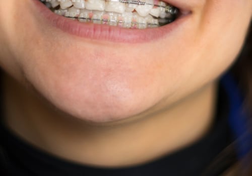Does Cosmetic Dentistry Include Braces?