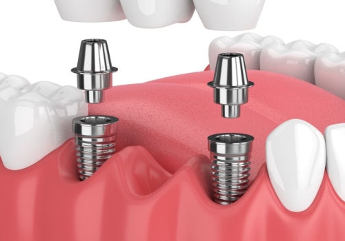 What are Dental Implants and How are They Classified?