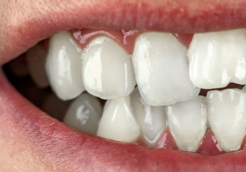 Can Cosmetic Dentistry Fix Crooked Teeth?