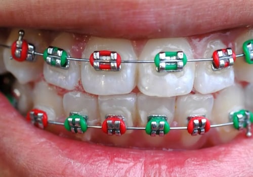 Can you get braces for aesthetic reasons?